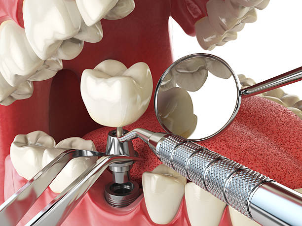 Best Emergency Dentist for Lost Fillings or Crowns in Millbrae, CA